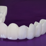 Facetas Odontológicas Removíveis - Prótese Superior e Prótese Inferior